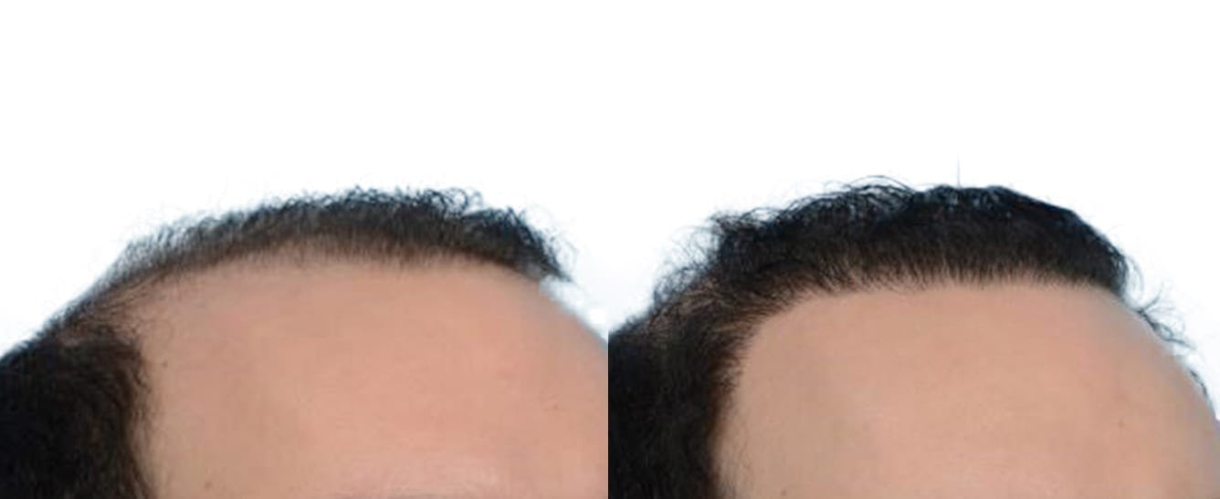 Hair Restoration  Before & After Gallery - Patient 259043 - Image 3