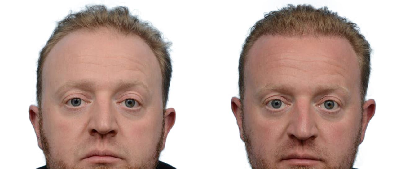 Hair Restoration  Before & After Gallery - Patient 393598 - Image 1