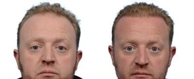 Hair Restoration Before & After Gallery - Patient 393598 - Image 1