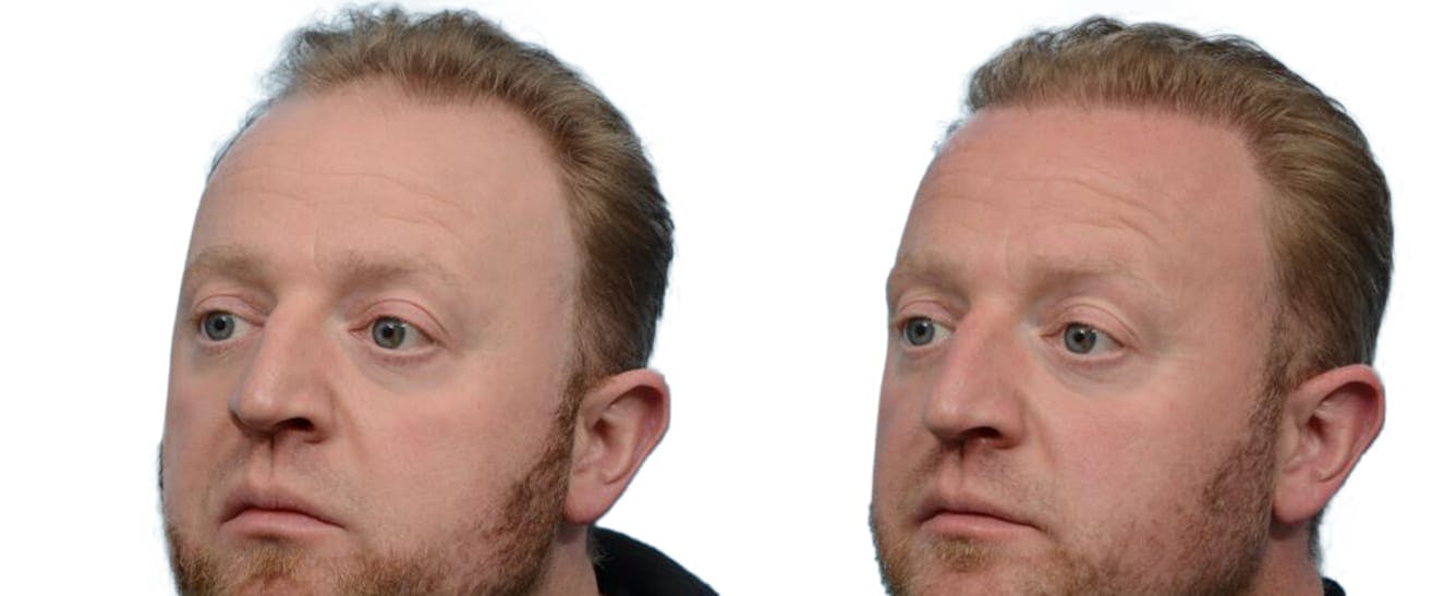 Hair Restoration  Before & After Gallery - Patient 393598 - Image 2