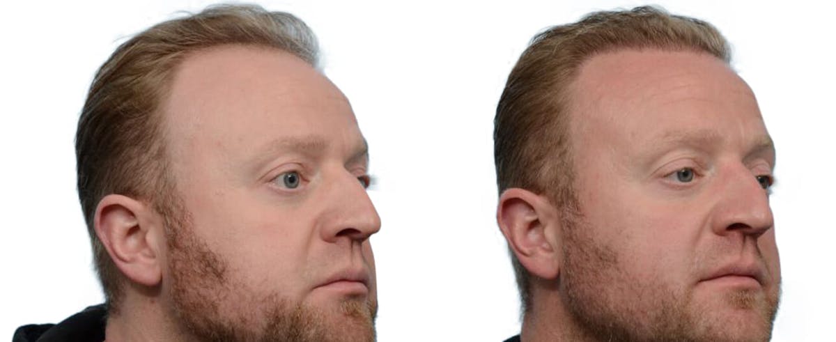 Hair Restoration Before & After Gallery - Patient 393598 - Image 3