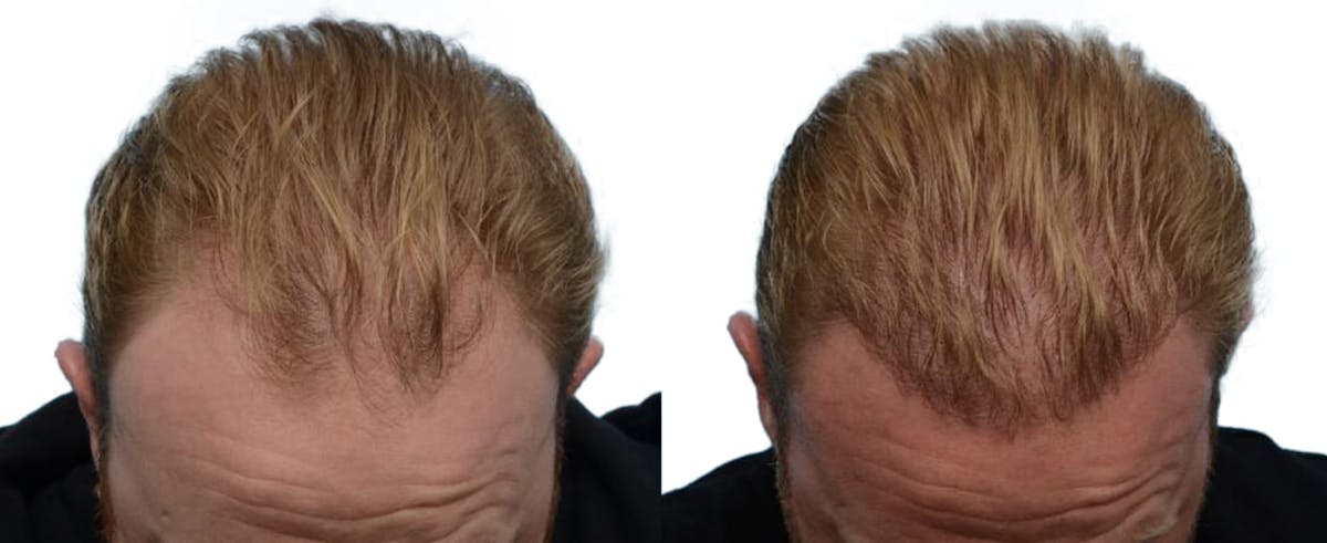FUE Hair Transplant Before & After Gallery - Patient 197600 - Image 4