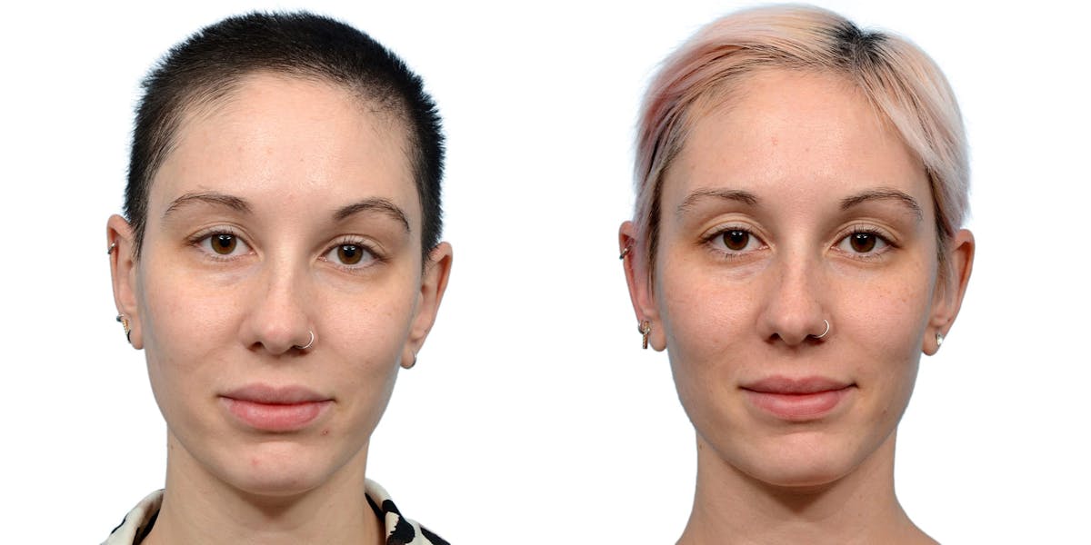 Hair Restoration Before & After Gallery - Patient 852360 - Image 2