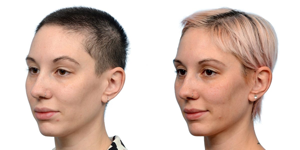 FUE Hair Transplant Before & After Gallery - Patient 559187 - Image 3