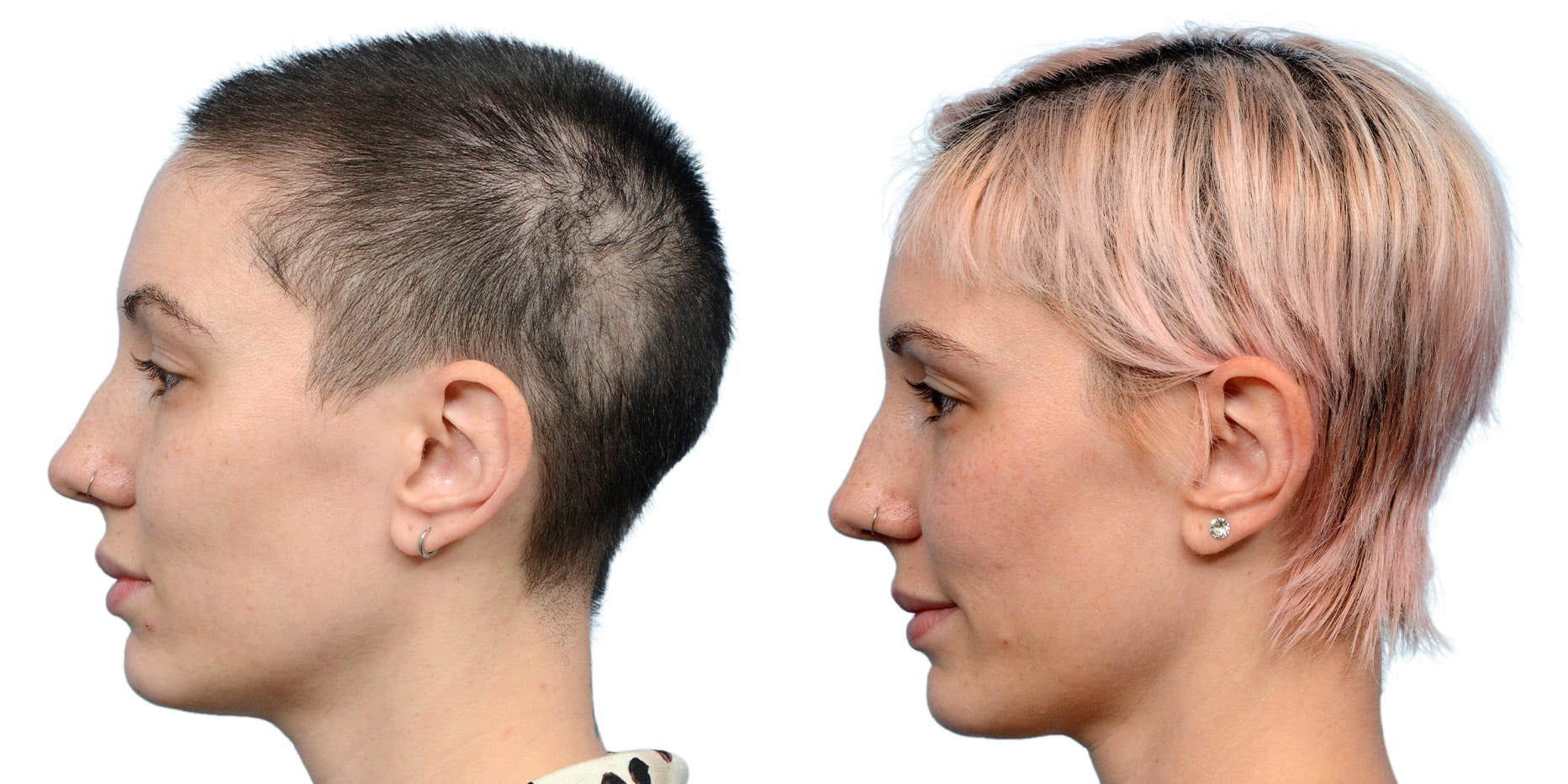 Hair Restoration Before & After Gallery - Patient 852360 - Image 4