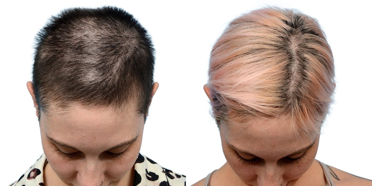 Female Hair Restoration Before & After Gallery - Patient 203823 - Image 5