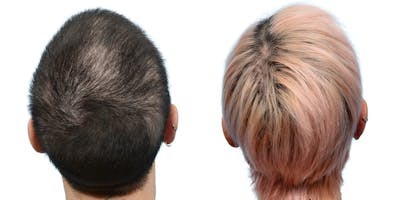FUE Hair Transplant Before & After Gallery - Patient 559187 - Image 1