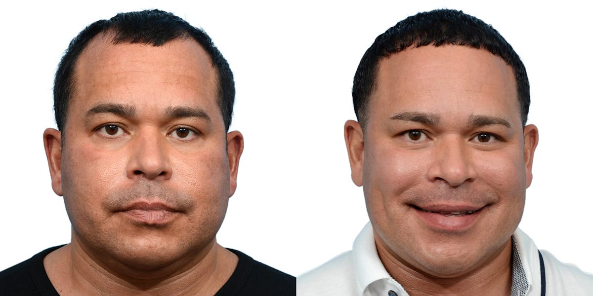 FUE Hair Transplant Before & After Gallery - Patient 102764 - Image 2