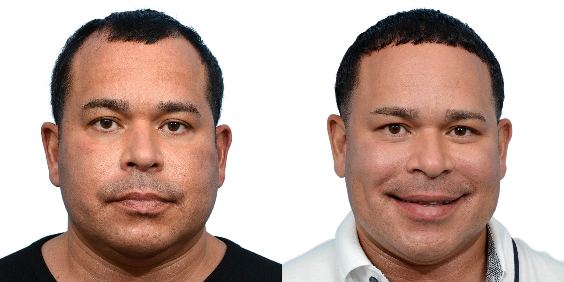 Hair Restoration  Before & After Gallery - Patient 324055 - Image 2