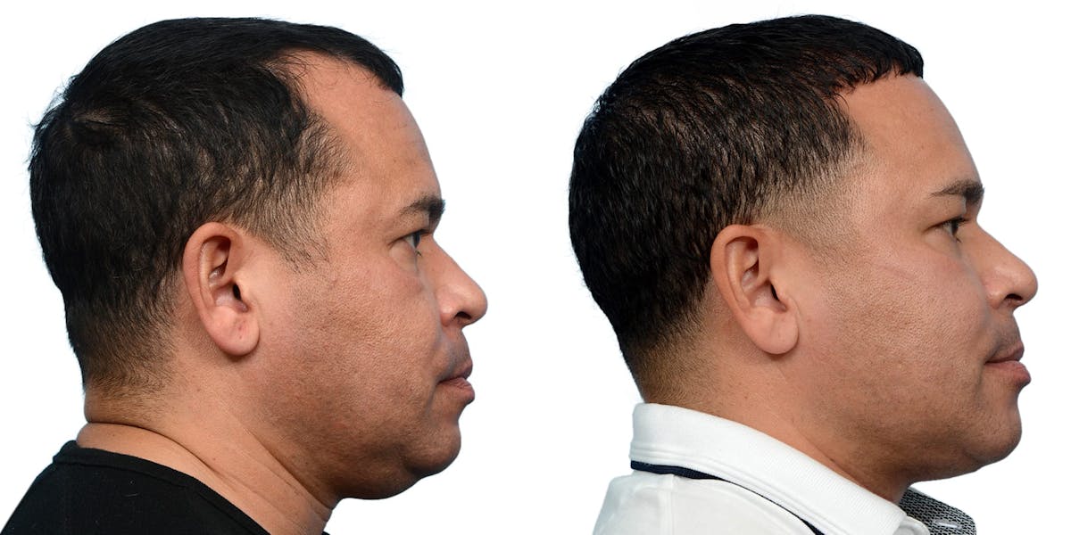 FUE Hair Transplant Before & After Gallery - Patient 102764 - Image 3
