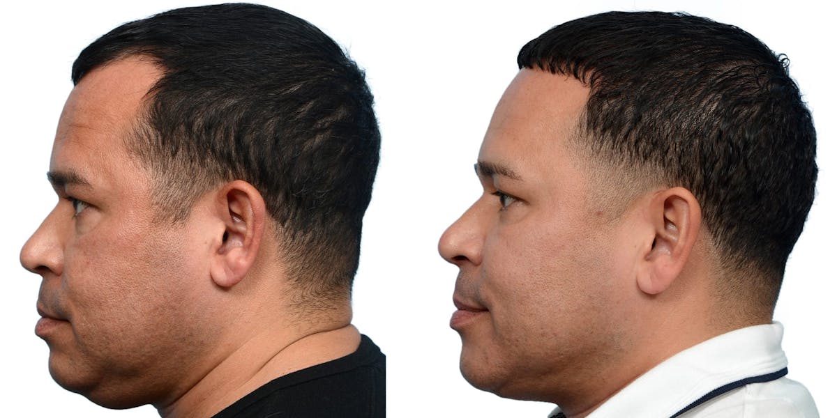 Hair Restoration Before & After Gallery - Patient 324055 - Image 4