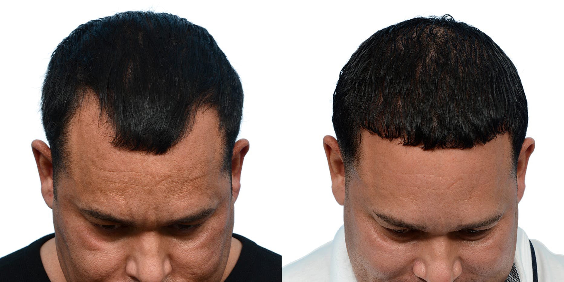 Hair Restoration  Before & After Gallery - Patient 324055 - Image 1