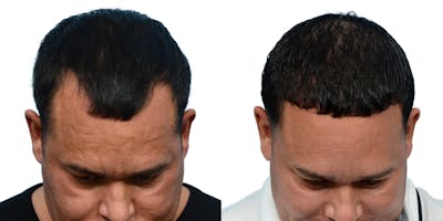 FUE Hair Transplant Before & After Gallery - Patient 102764 - Image 1
