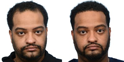 FUE Hair Transplant Before & After Gallery - Patient 373700 - Image 1