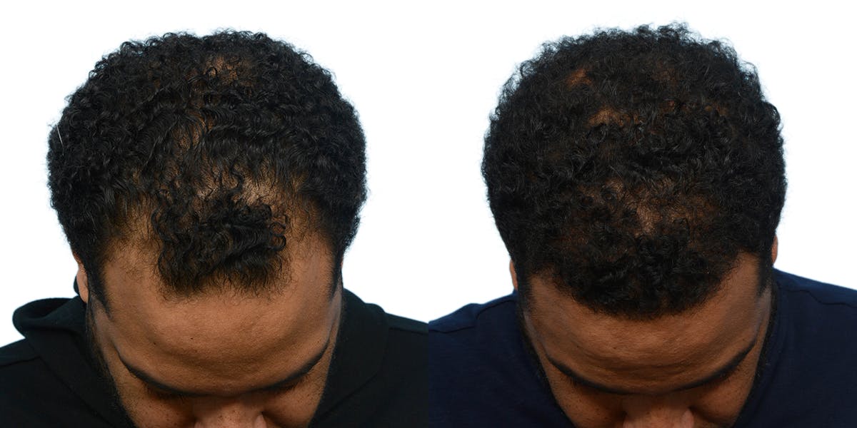 FUE Hair Transplant Before & After Gallery - Patient 373700 - Image 2