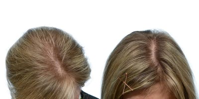Hair Restoration Before & After Gallery - Patient 363424 - Image 1