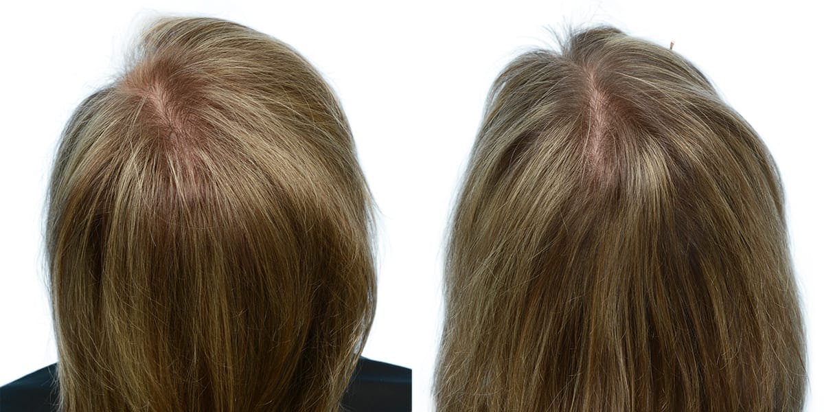 Female Hair Restoration Before & After Gallery - Patient 383917 - Image 2
