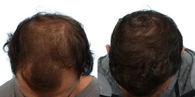 FUE Hair Transplant Before & After Gallery - Patient 248168 - Image 1
