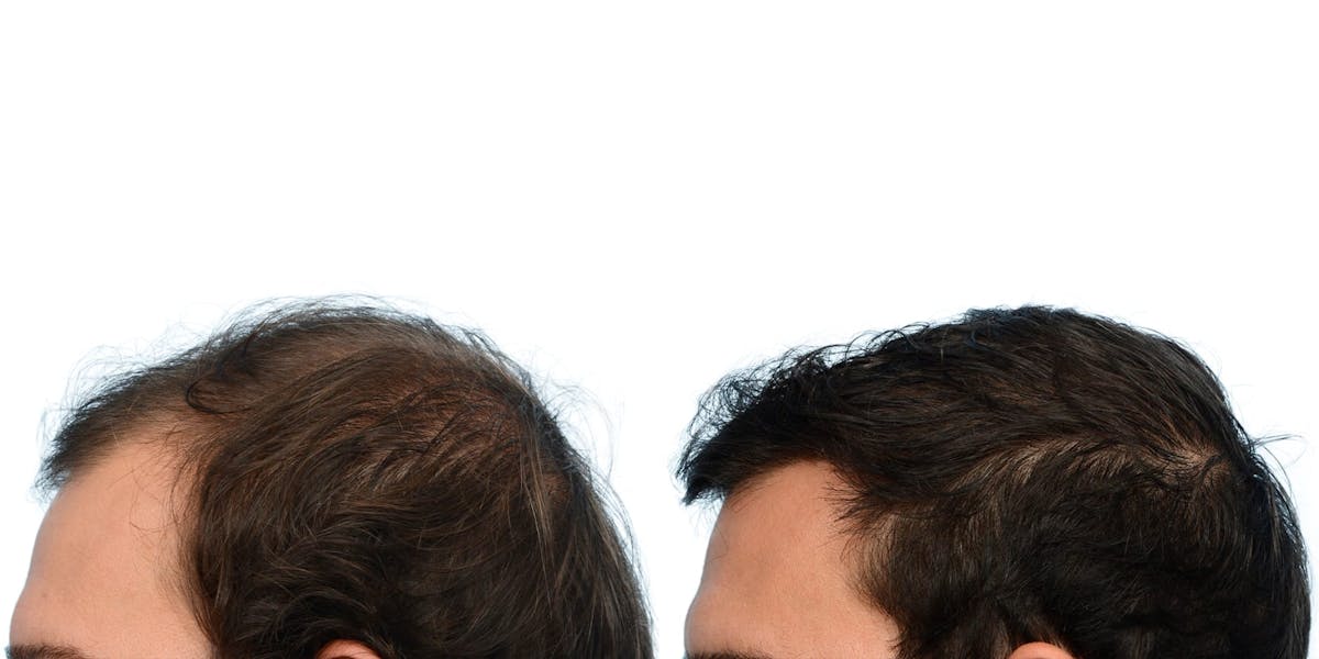 FUE Hair Transplant Before & After Gallery - Patient 248168 - Image 2