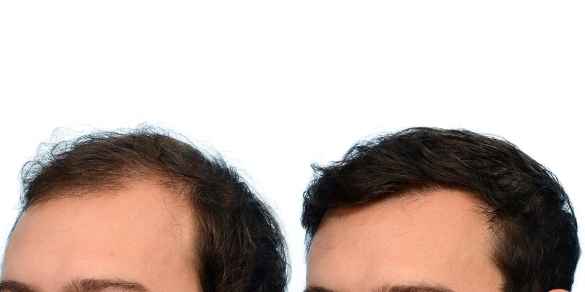 Hair Restoration Before & After Gallery - Patient 351417 - Image 3