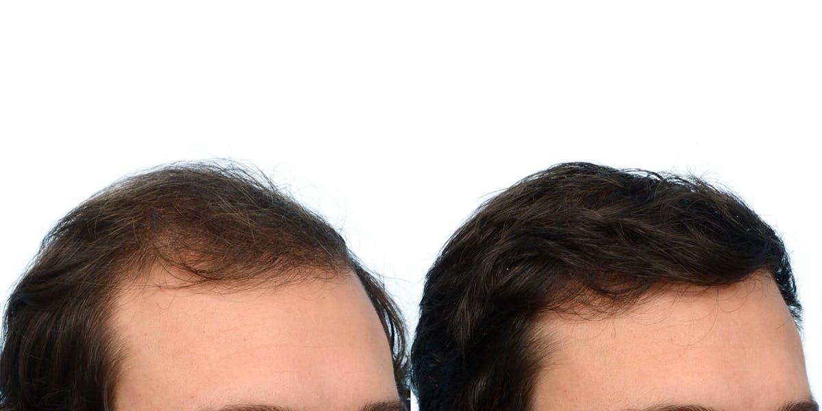 Hair Restoration Before & After Gallery - Patient 351417 - Image 4
