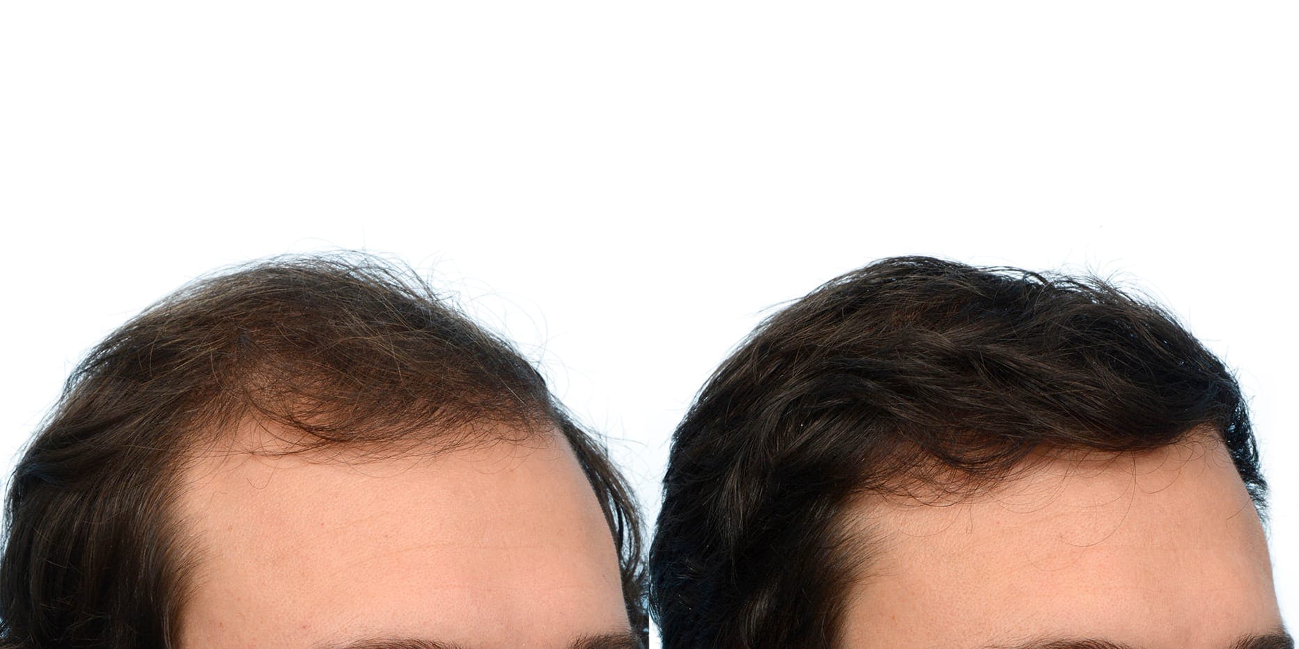 Hair Restoration  Before & After Gallery - Patient 351417 - Image 4