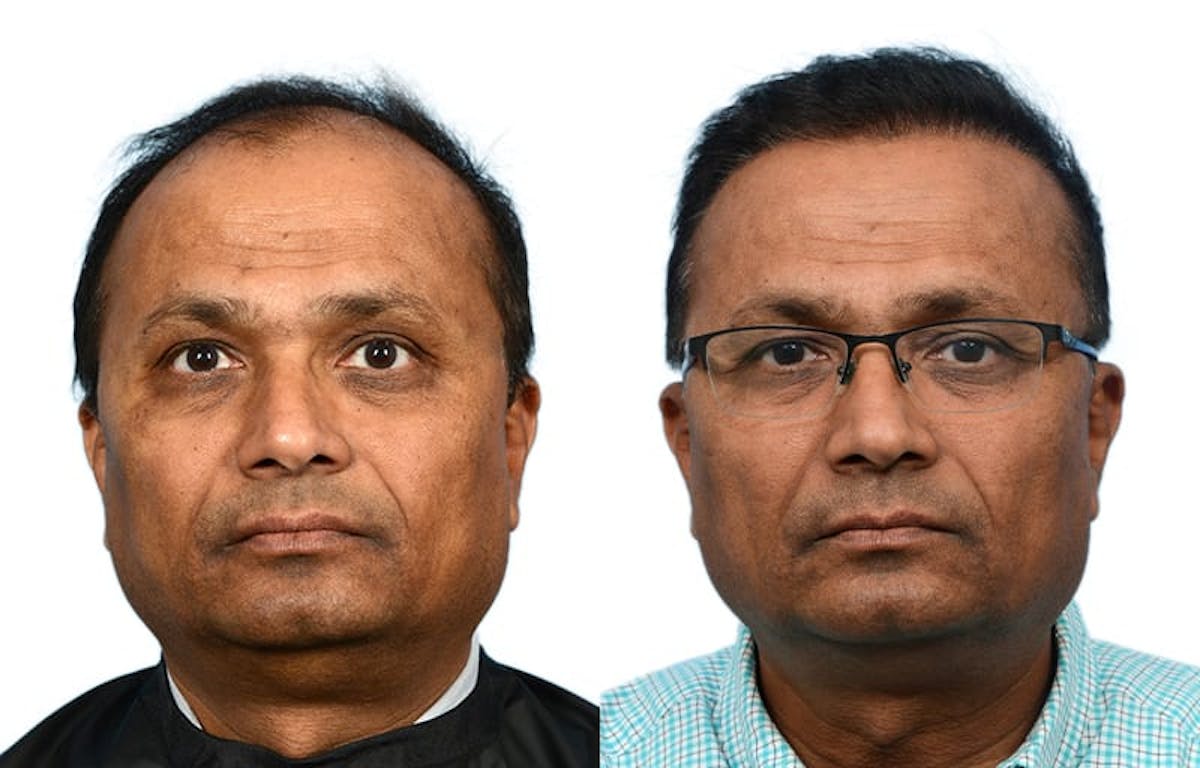 FUE Hair Transplant Before & After Gallery - Patient 319979 - Image 2