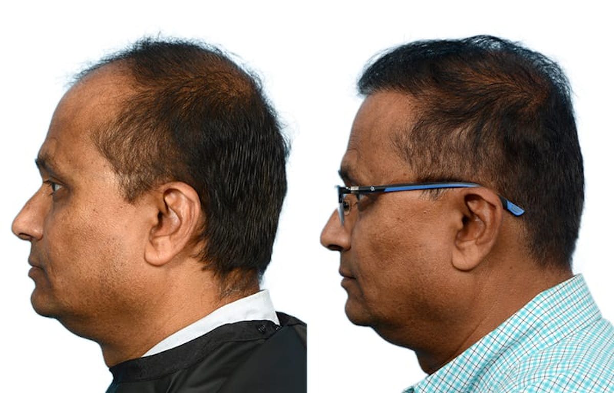 Hair Restoration Before & After Gallery - Patient 158622 - Image 4