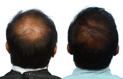 Hair Restoration Before & After Gallery - Patient 158622 - Image 1