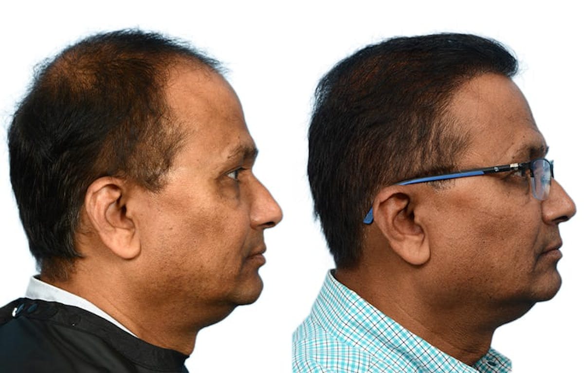 FUE Hair Transplant Before & After Gallery - Patient 319979 - Image 6