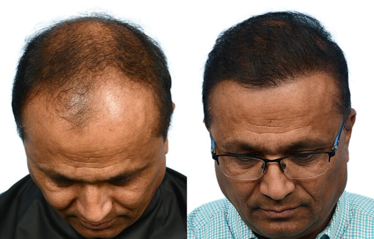 Hair Restoration Before & After Gallery - Patient 158622 - Image 7