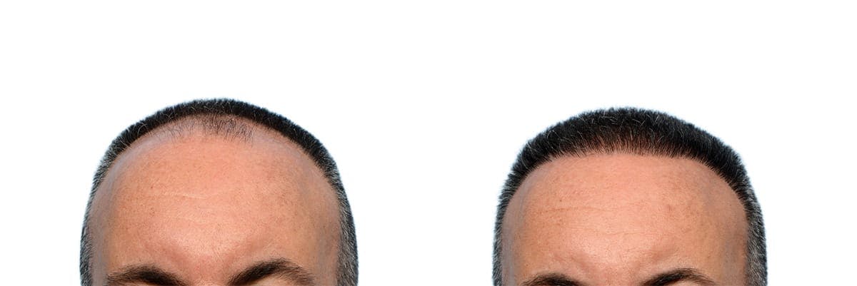 FUE Hair Transplant Before & After Gallery - Patient 100030 - Image 2