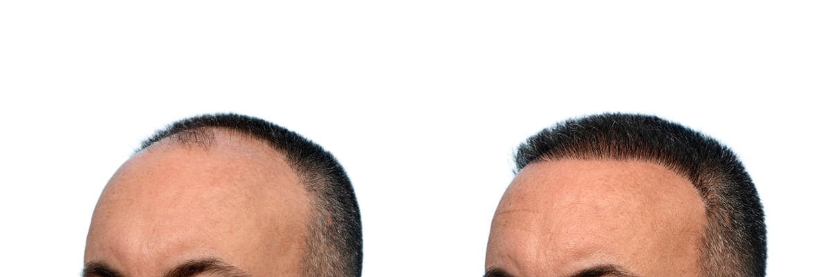 FUE Hair Transplant Before & After Gallery - Patient 100030 - Image 3