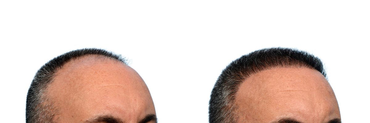 FUE Hair Transplant Before & After Gallery - Patient 100030 - Image 4