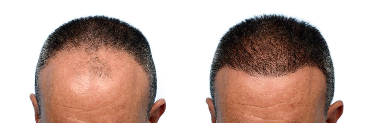FUE Hair Transplant Before & After Gallery - Patient 100030 - Image 1