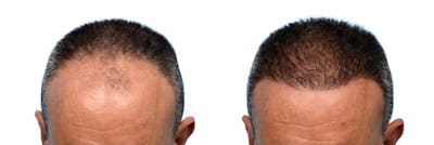 Hair Restoration Before & After Gallery - Patient 337969 - Image 1