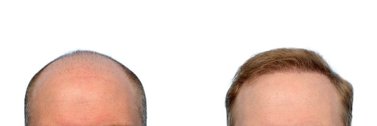 Hair Restoration Before & After Gallery - Patient 300290 - Image 1