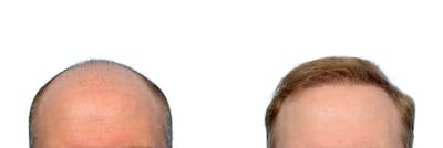 FUE Hair Transplant Before & After Gallery - Patient 317934 - Image 1