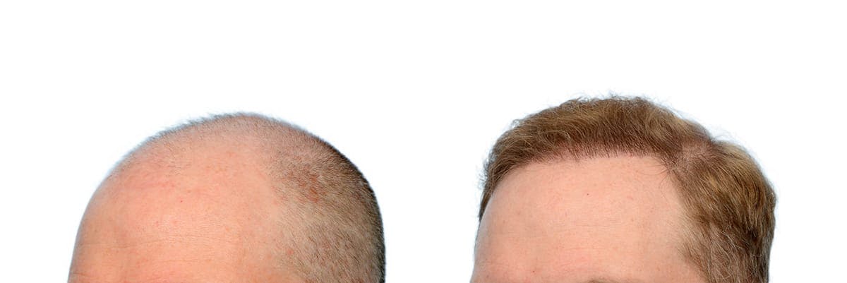 Hair Restoration Before & After Gallery - Patient 300290 - Image 2