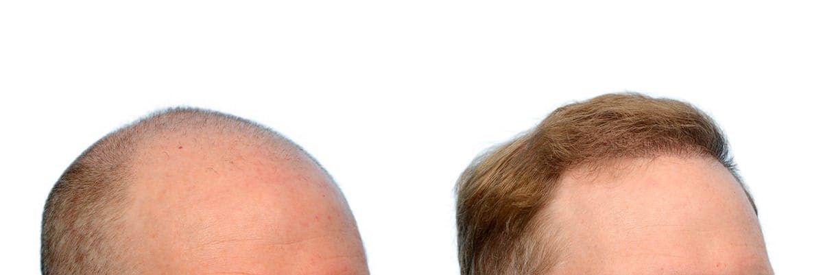 FUE Hair Transplant Before & After Gallery - Patient 317934 - Image 3
