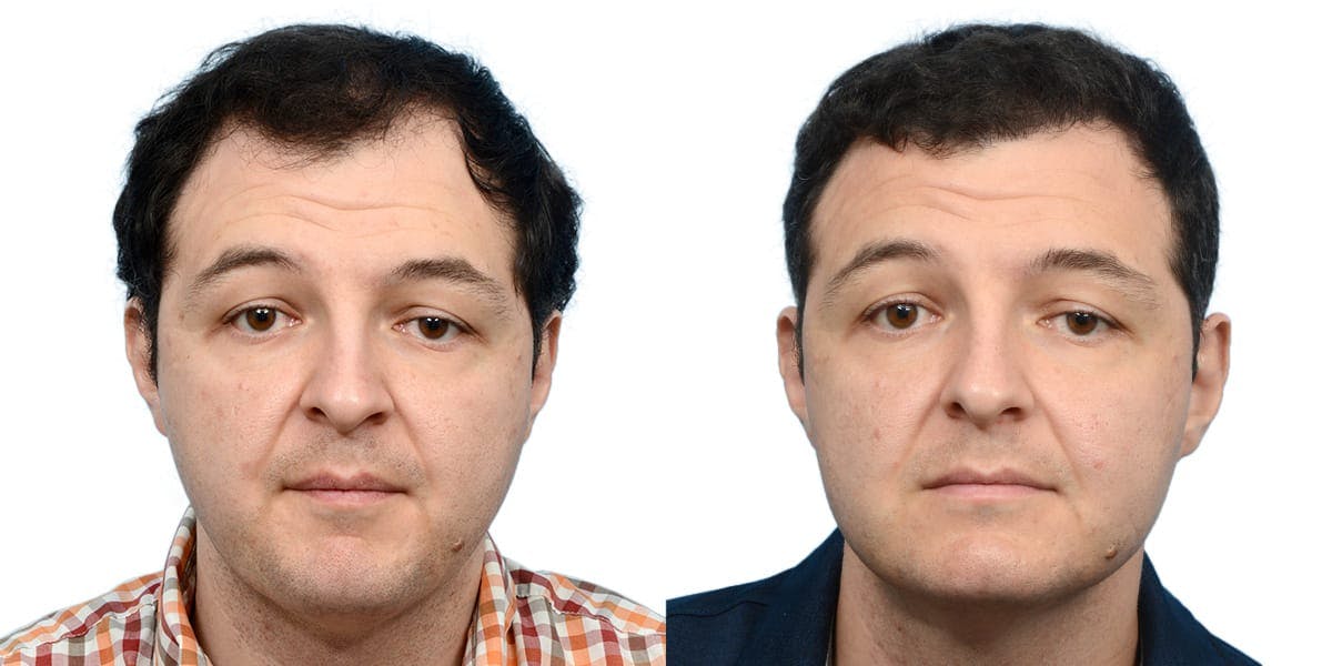 FUE Hair Transplant Before & After Gallery - Patient 270827 - Image 3