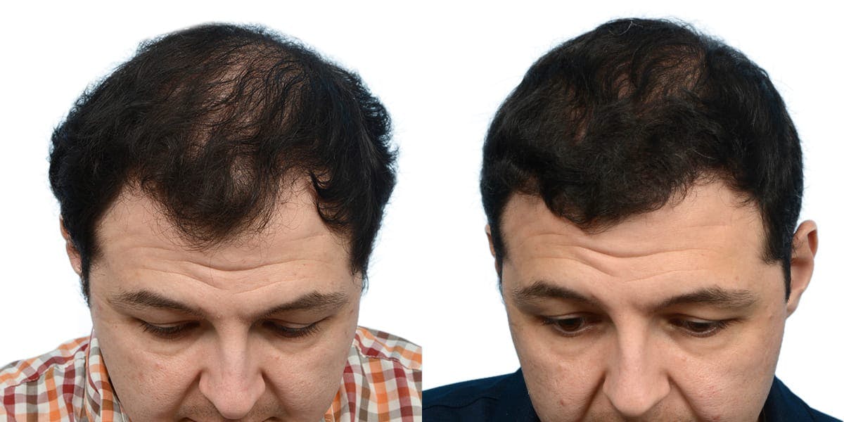 FUE Hair Transplant Before & After Gallery - Patient 270827 - Image 2