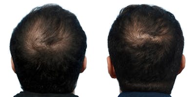 Hair Restoration Before & After Gallery - Patient 162751 - Image 1