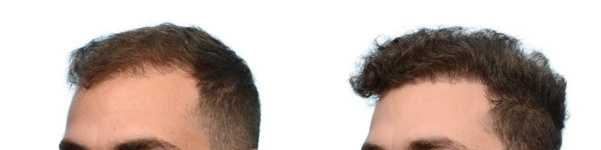 Hair Restoration Before & After Gallery - Patient 720628 - Image 3