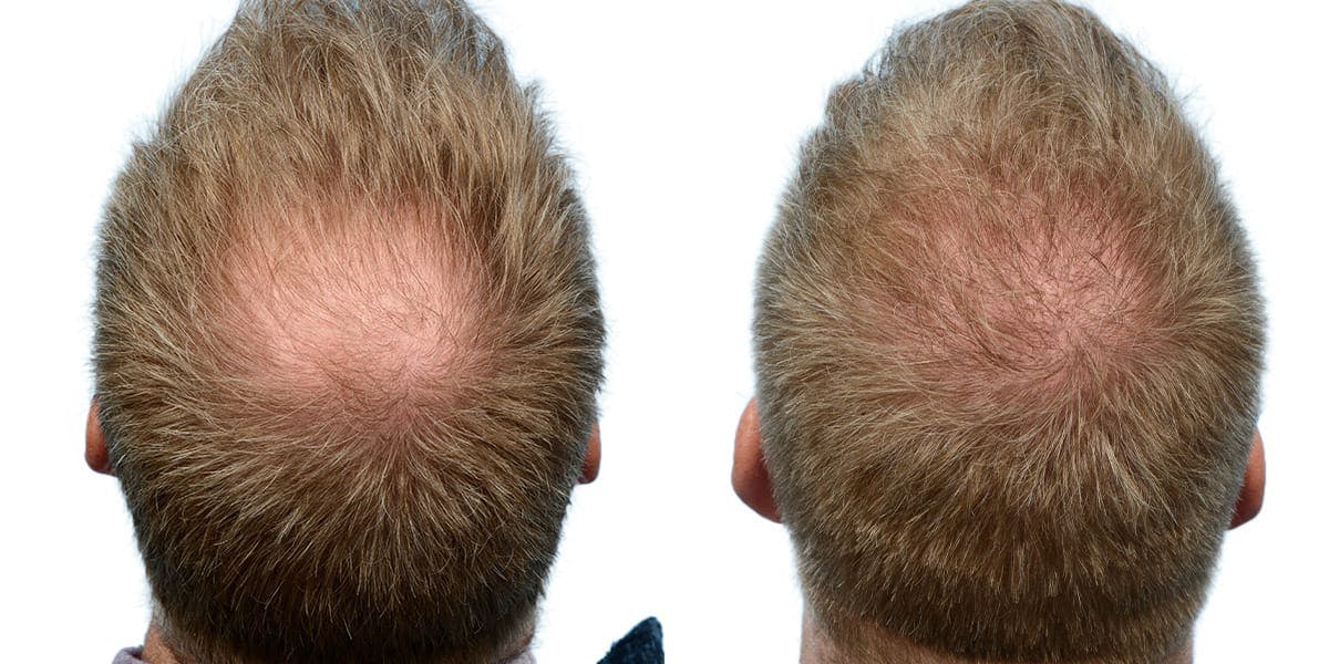 Hair Restoration Before & After Gallery - Patient 160071 - Image 1