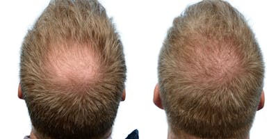 FUE Hair Transplant Before & After Gallery - Patient 152955 - Image 1