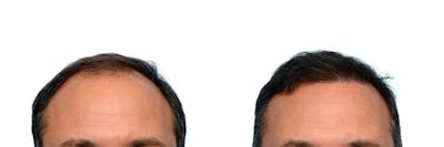 FUE Hair Transplant Before & After Gallery - Patient 320523 - Image 1