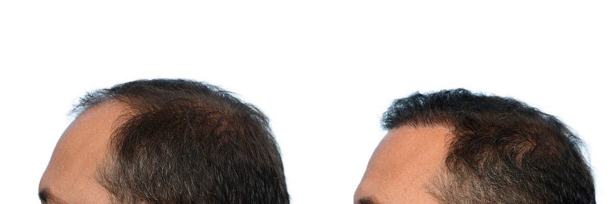 Hair Restoration Before & After Gallery - Patient 304379 - Image 3
