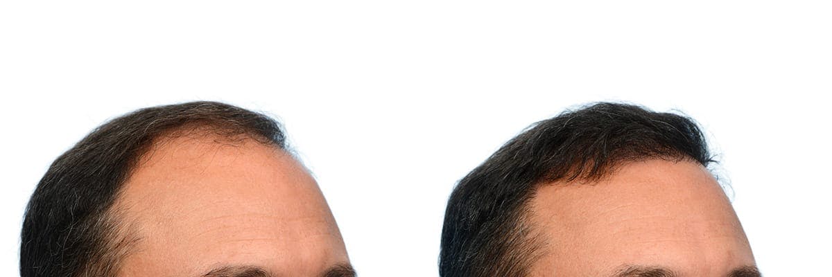 FUE Hair Transplant Before & After Gallery - Patient 320523 - Image 4
