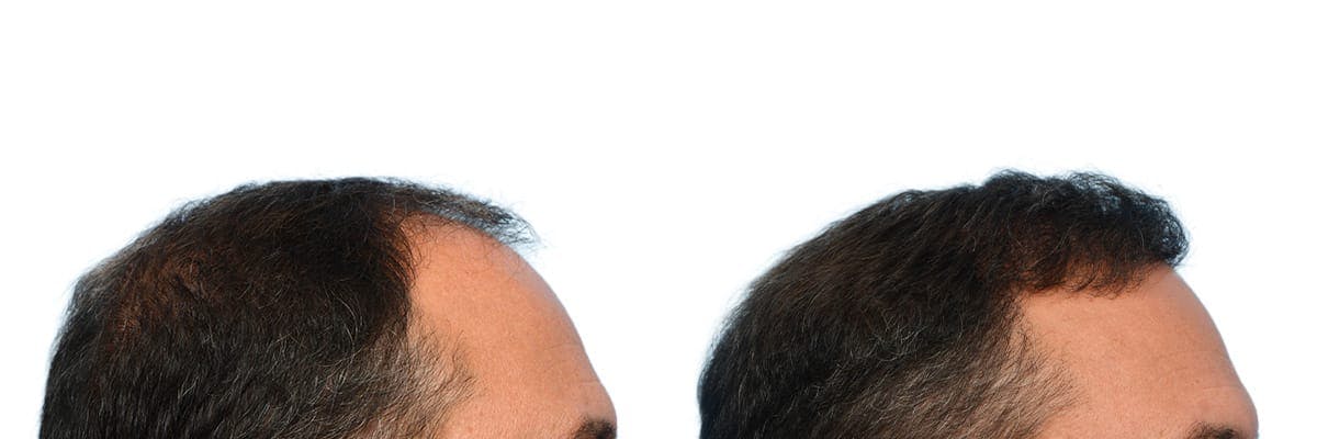 FUE Hair Transplant Before & After Gallery - Patient 320523 - Image 5
